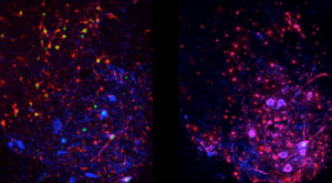 ALS disease under microscope